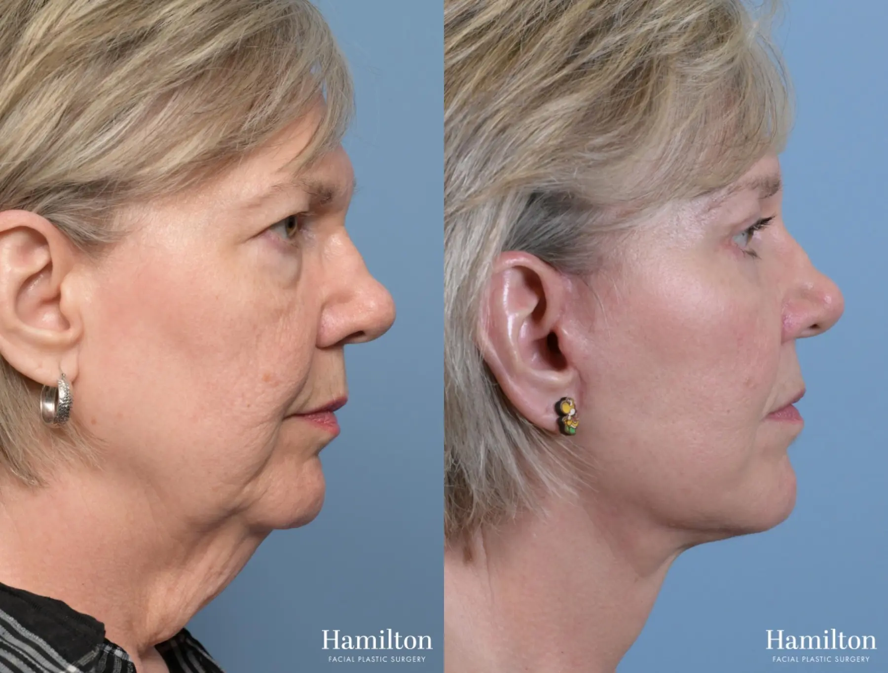 Neck Rejuvenation: Patient 2 - Before and After 2