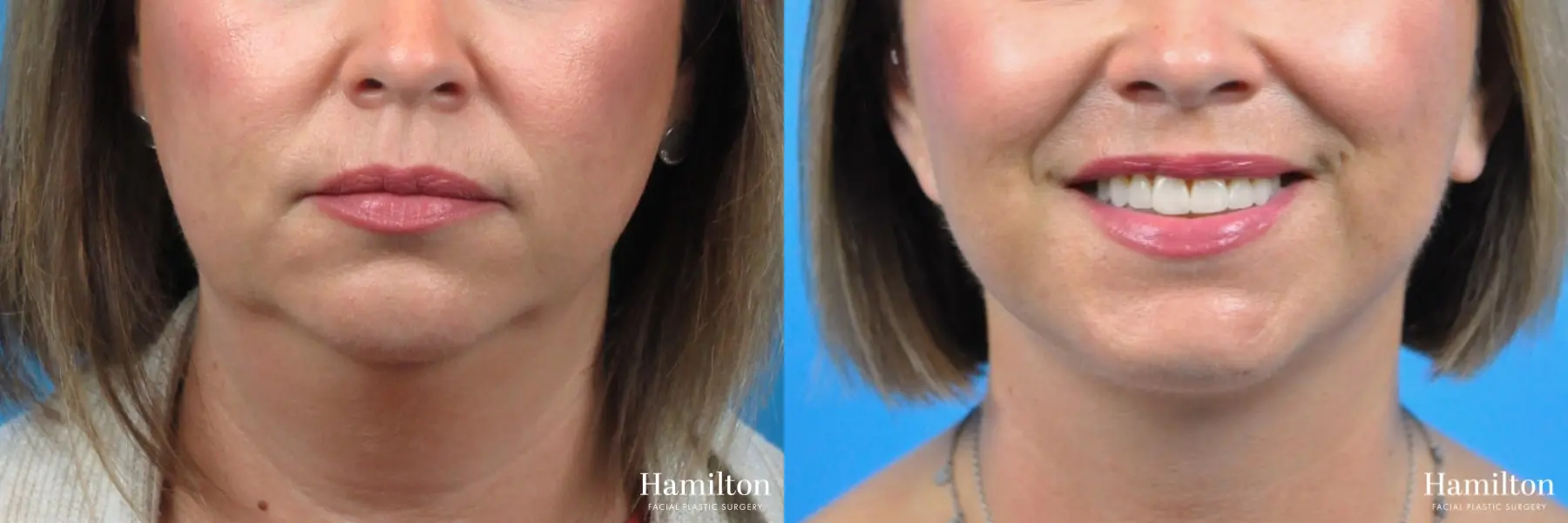 Neck Rejuvenation: Patient 13 - Before and After 2