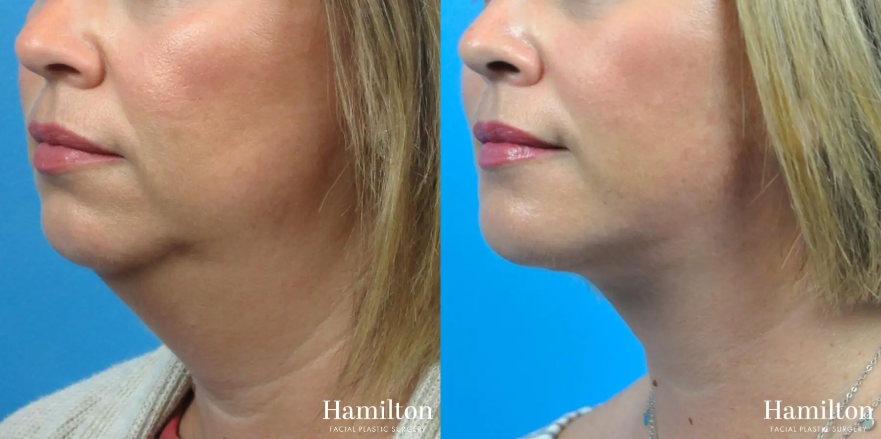 Neck Rejuvenation: Patient 13 - Before and After 3