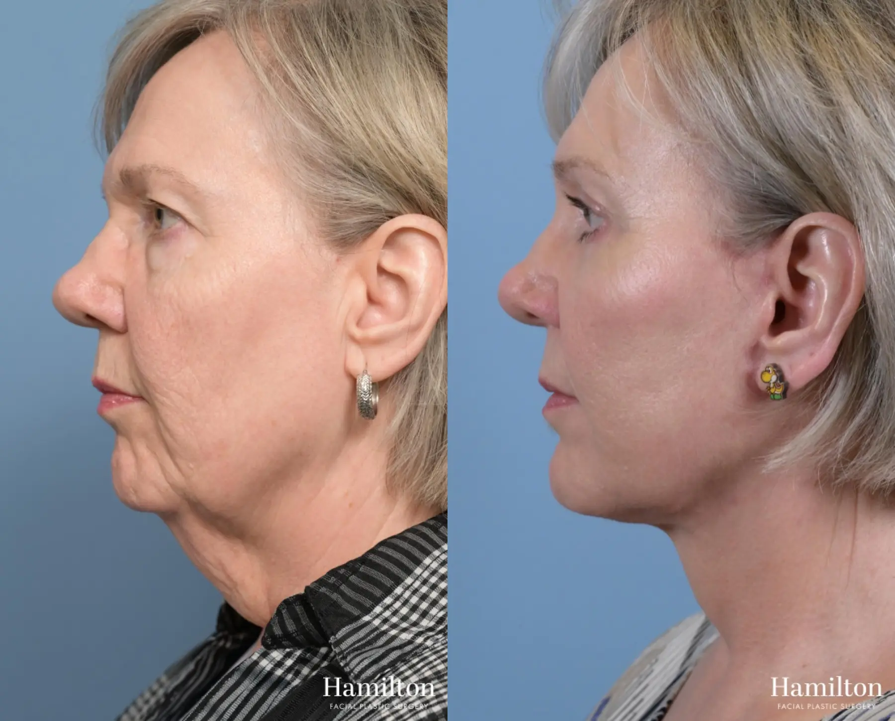 Neck Rejuvenation: Patient 2 - Before and After 1