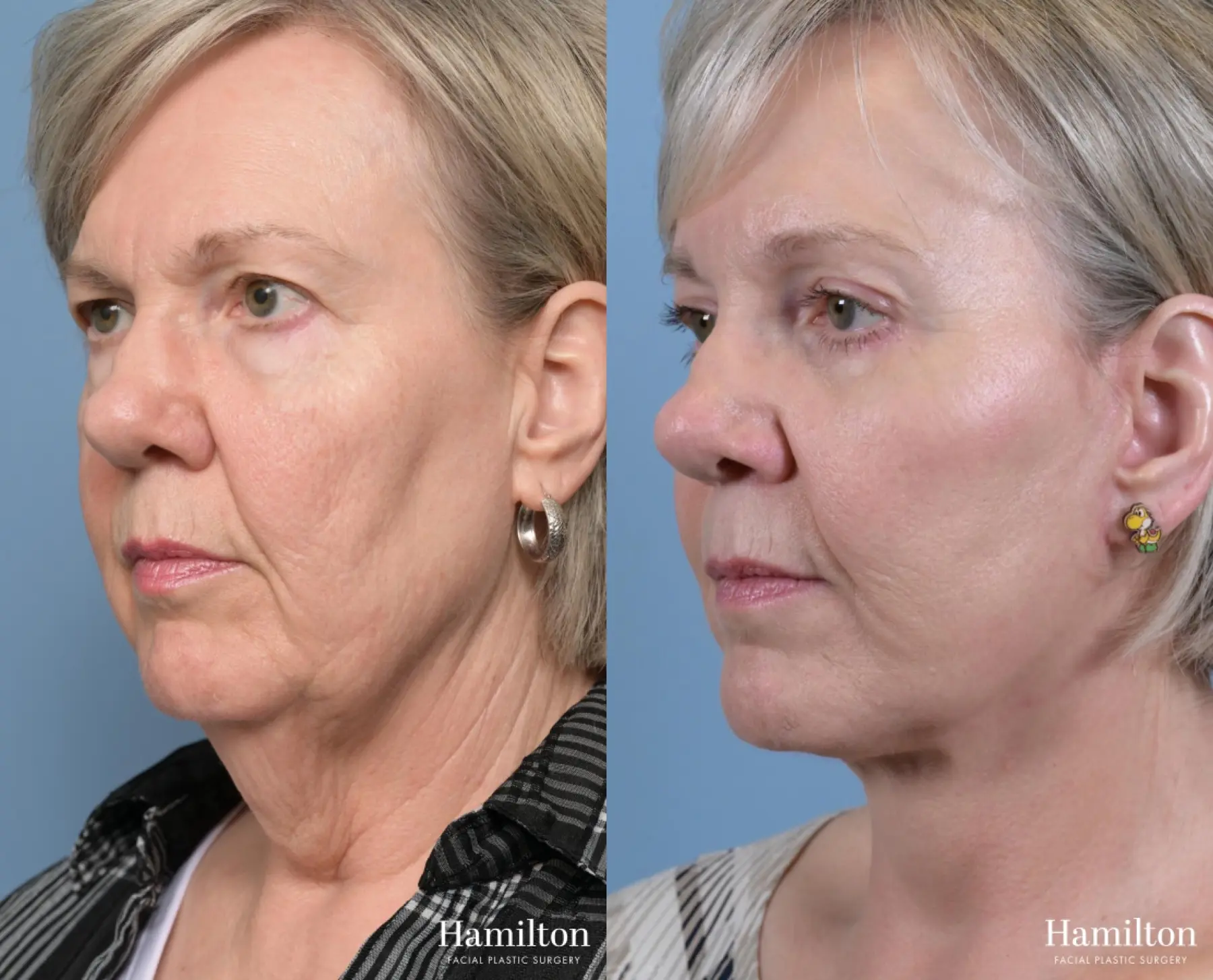 Neck Rejuvenation: Patient 2 - Before and After 4