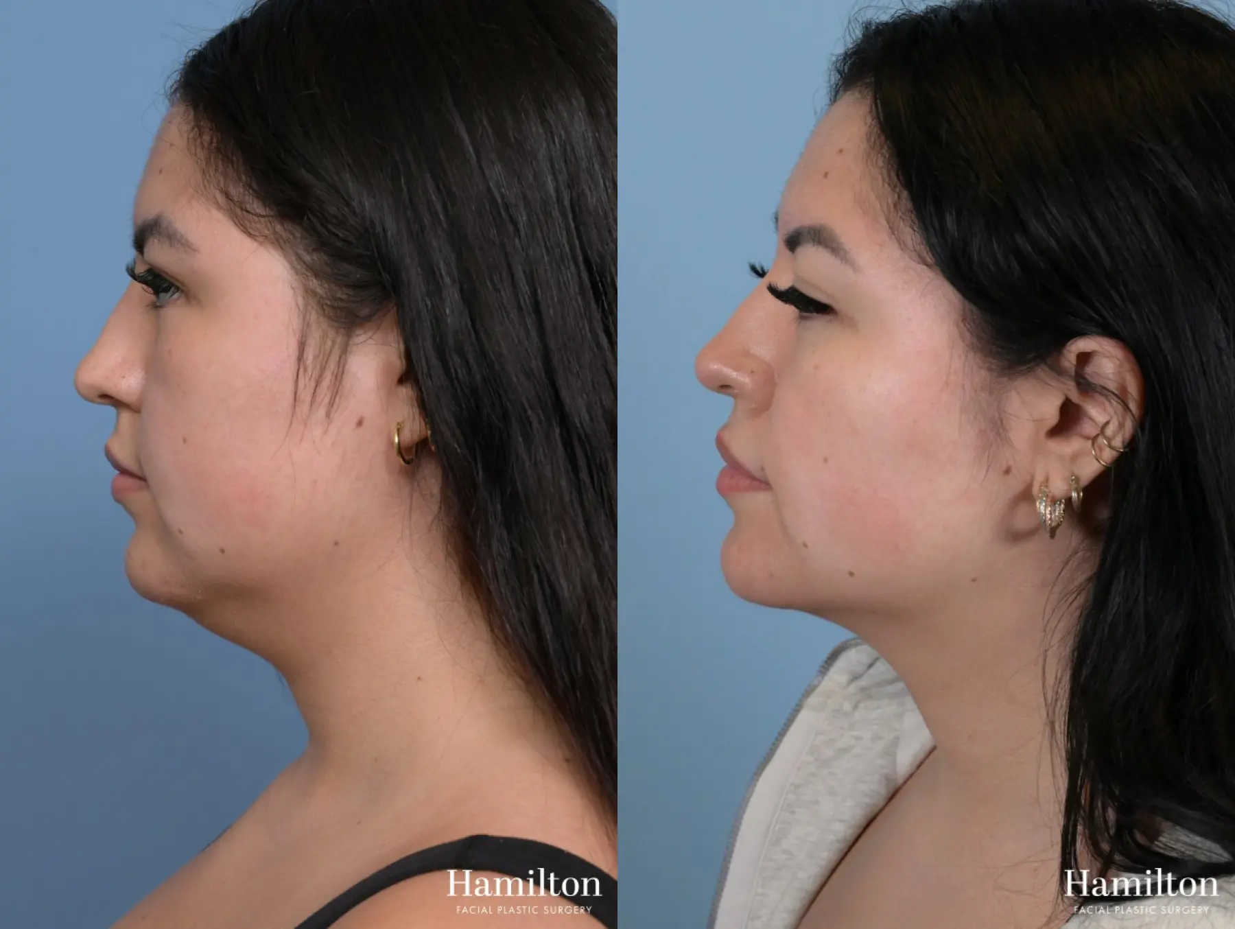 Neck Rejuvenation: Patient 12 - Before and After 1
