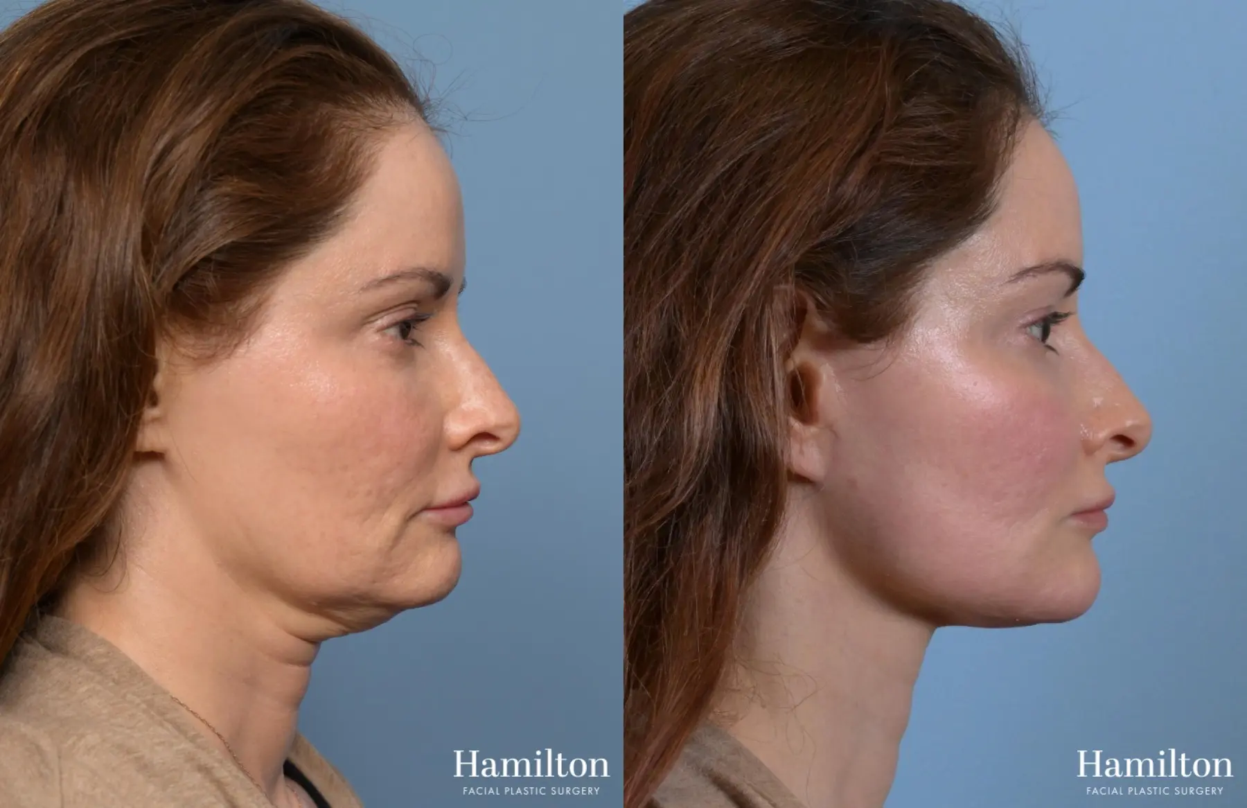 Neck Rejuvenation: Patient 1 - Before and After 1