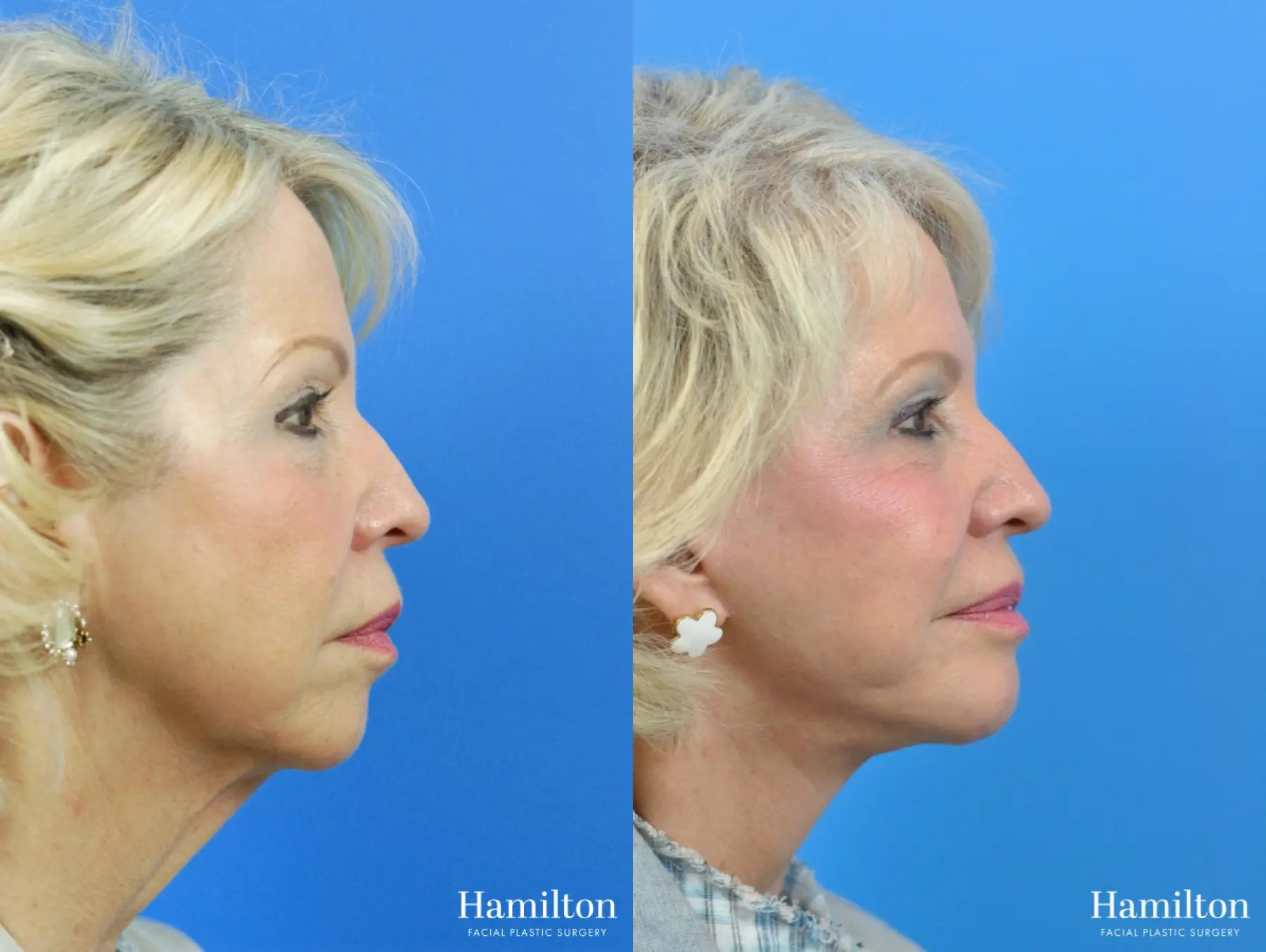 Neck Rejuvenation: Patient 11 - Before and After  