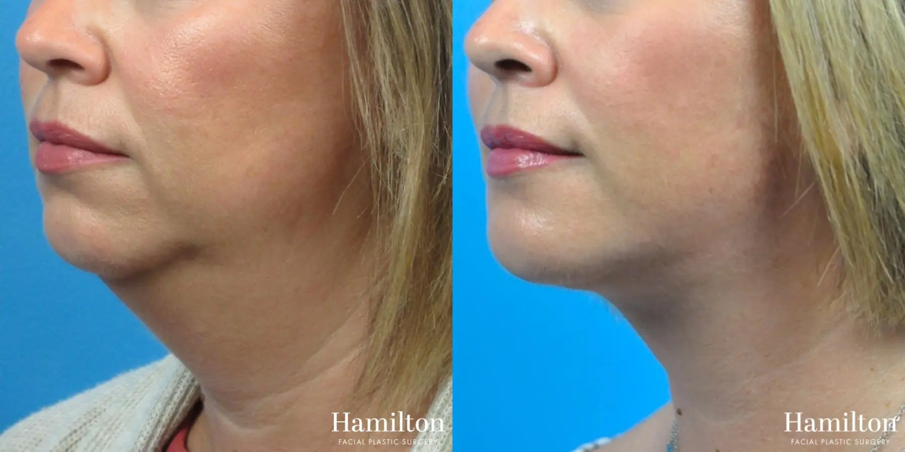 Neck Rejuvenation: Patient 6 - Before and After 3