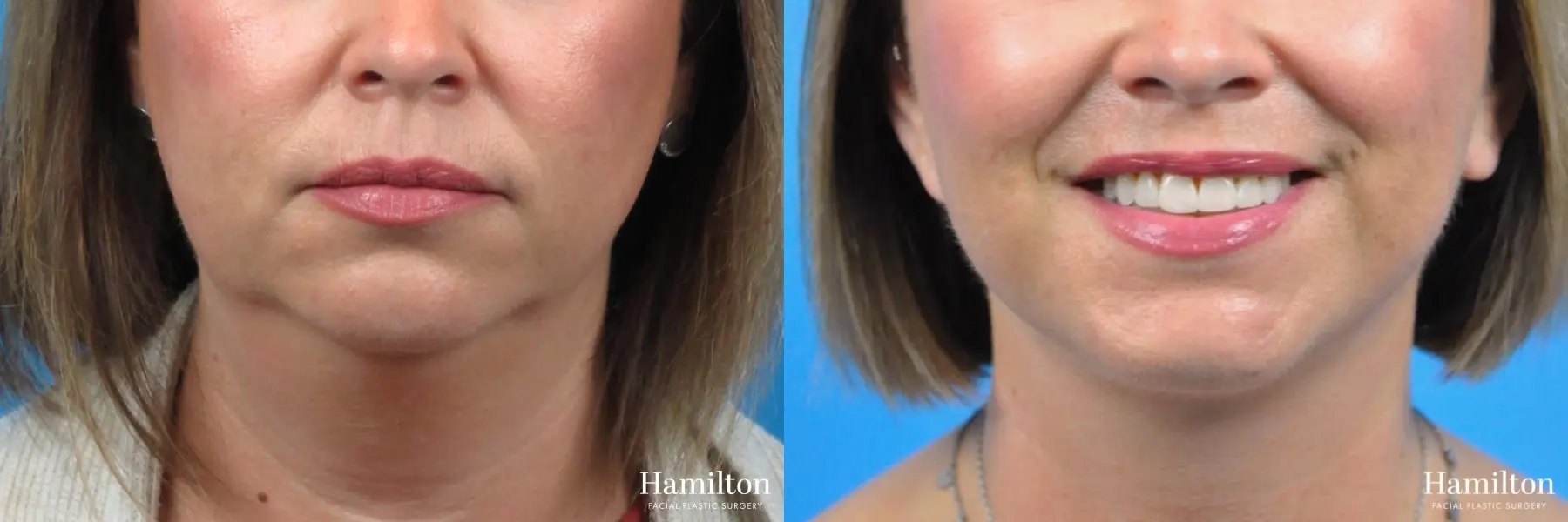 Neck Rejuvenation: Patient 6 - Before and After 2