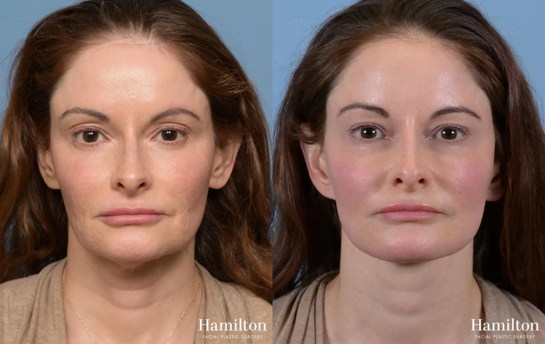 Neck Rejuvenation: Patient 1 - Before and After 5