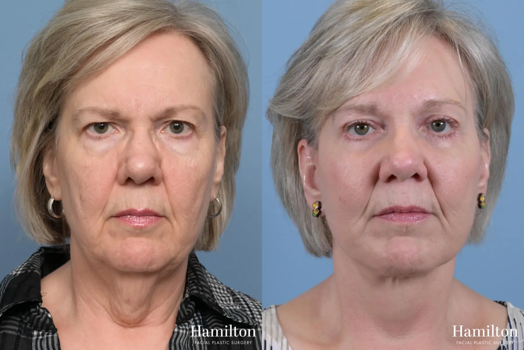Neck Rejuvenation: Patient 2 - Before and After 5
