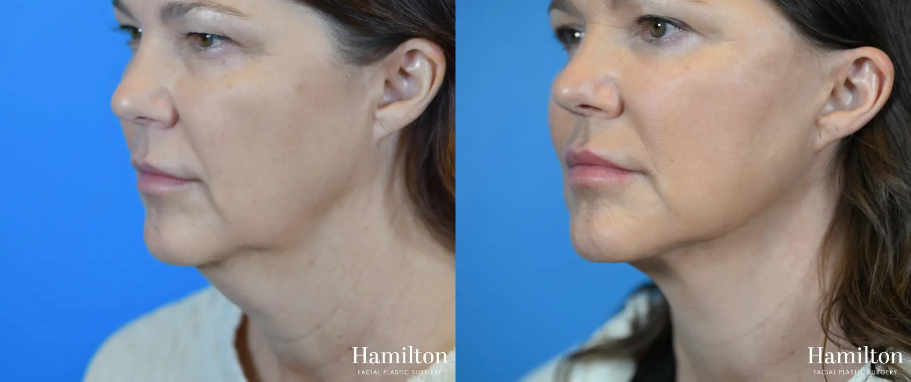 Neck Rejuvenation: Patient 10 - Before and After 3