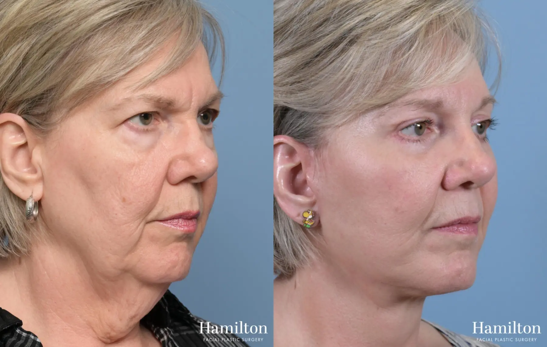 Neck Rejuvenation: Patient 2 - Before and After 3