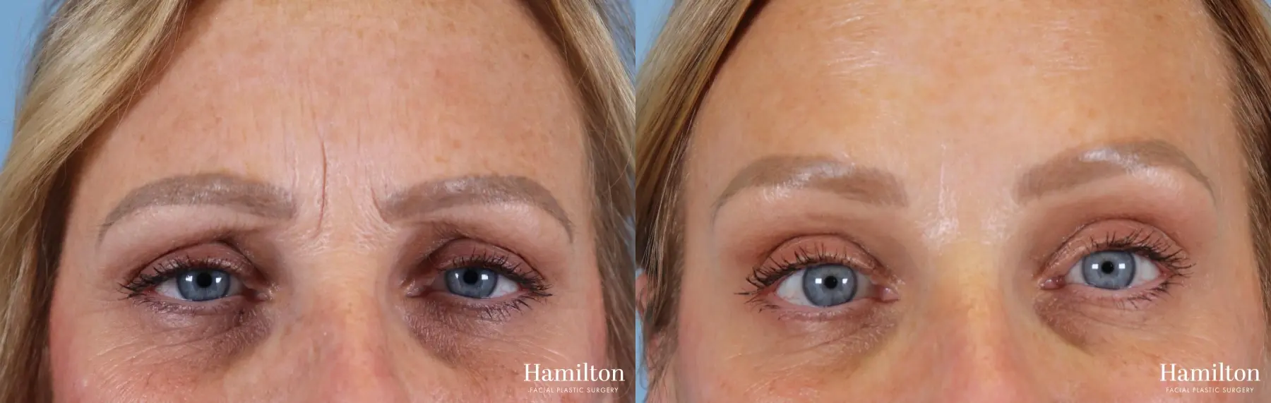 Neurotoxins/Botox: Patient 4 - Before and After  