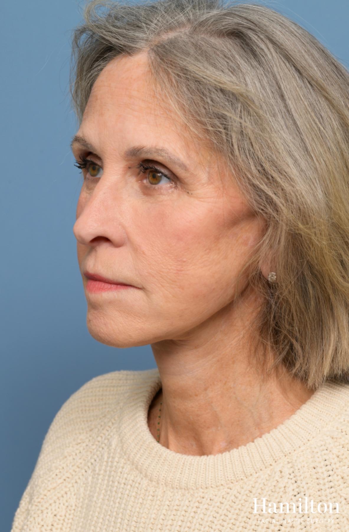 Fat Grafting: Patient 1 - After 4