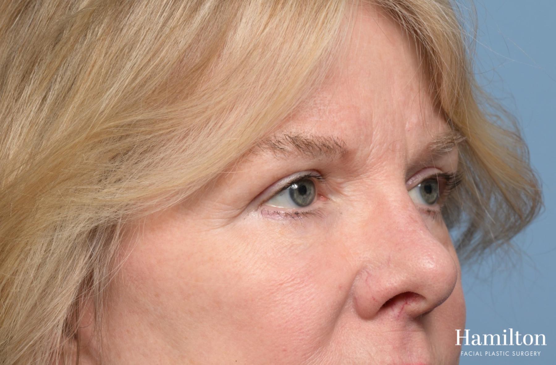 Blepharoplasty: Patient 11 - After 1
