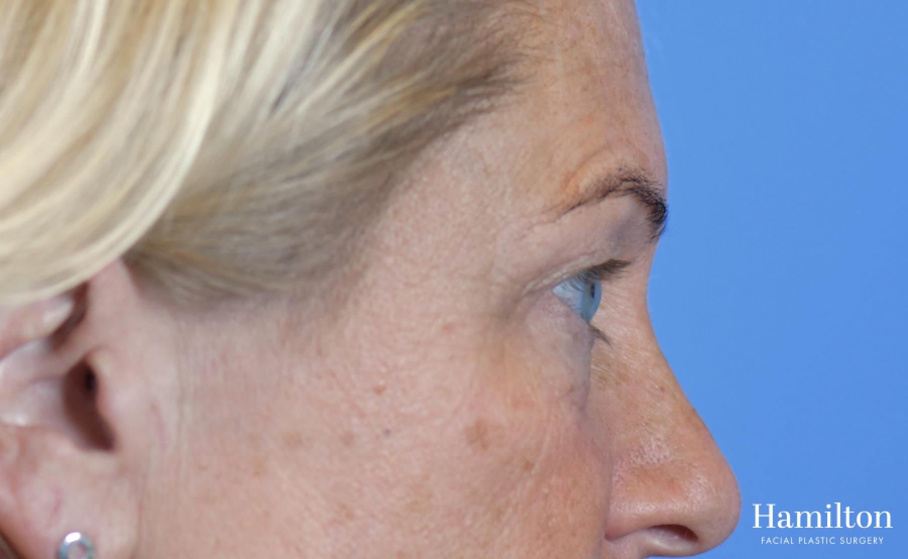 Blepharoplasty: Patient 23 - Before 3