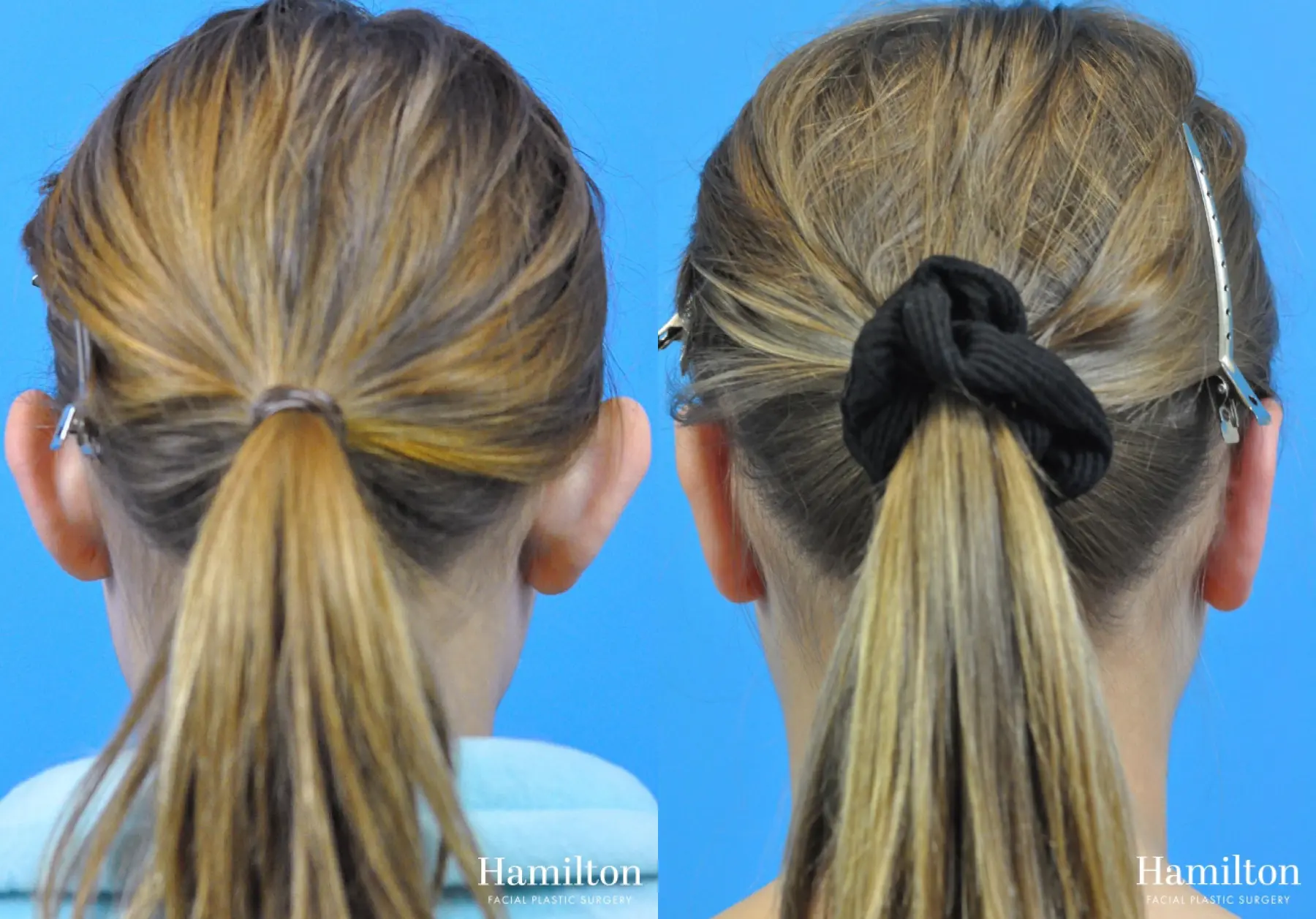 Otoplasty: Patient 4 - Before and After 2