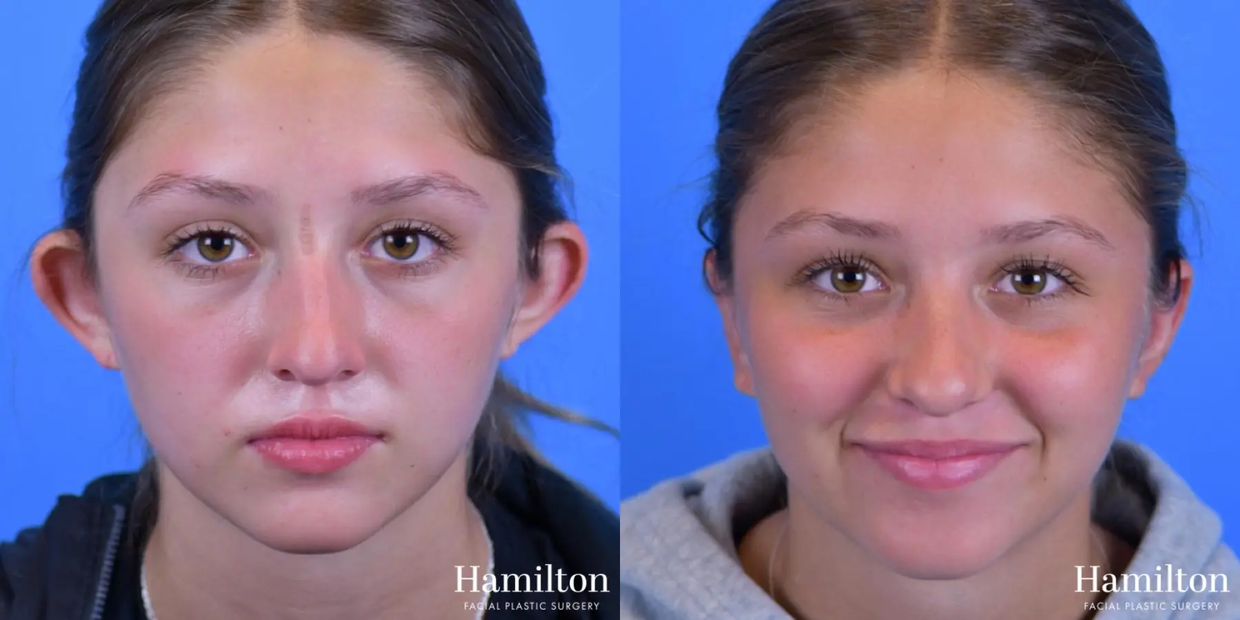 Otoplasty: Patient 1 - Before and After  