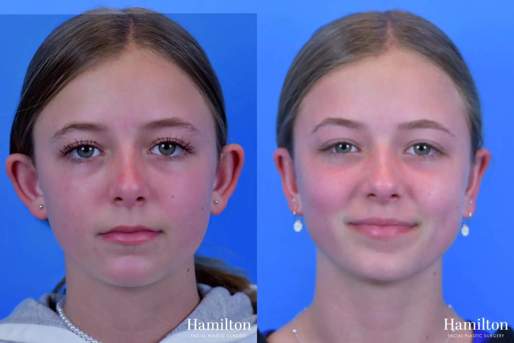 Otoplasty: Patient 2 - Before and After 1