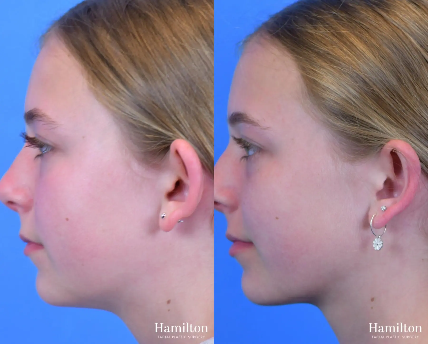Otoplasty: Patient 2 - Before and After 3