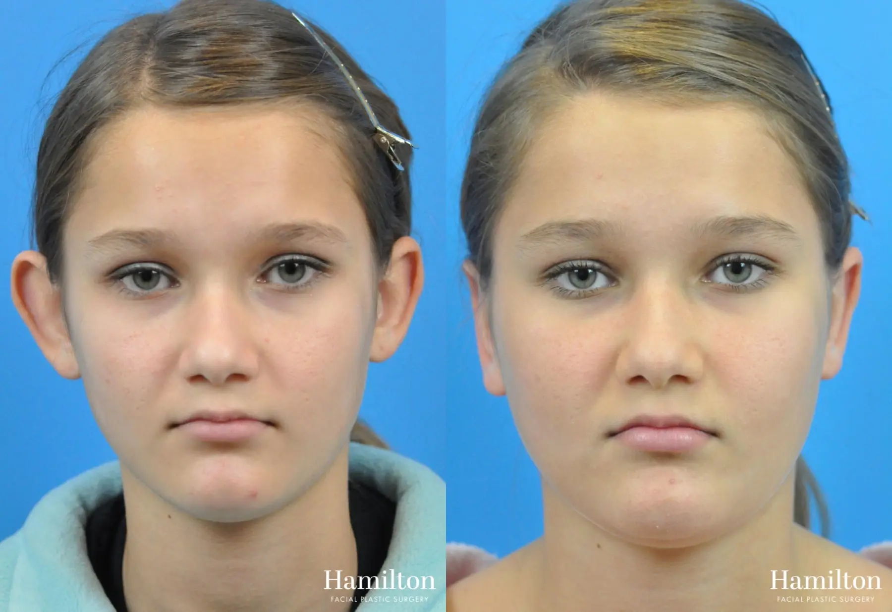 Otoplasty: Patient 4 - Before and After  
