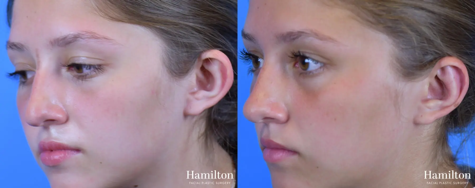 Otoplasty: Patient 1 - Before and After 4