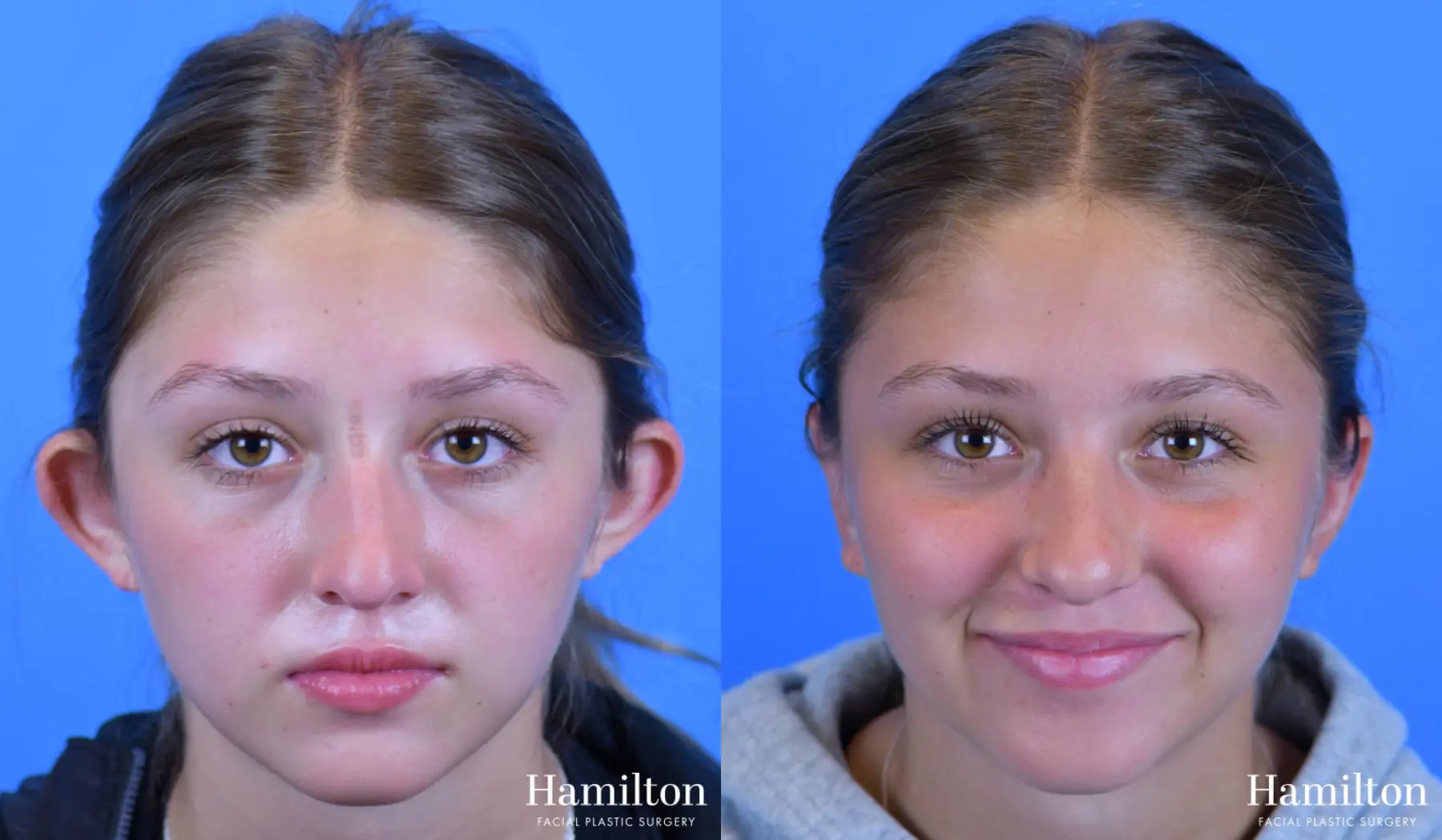 Otoplasty: Patient 1 - Before and After  