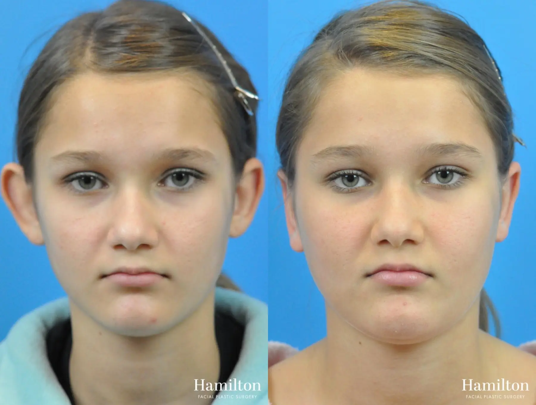 Otoplasty: Patient 2 - Before and After 1