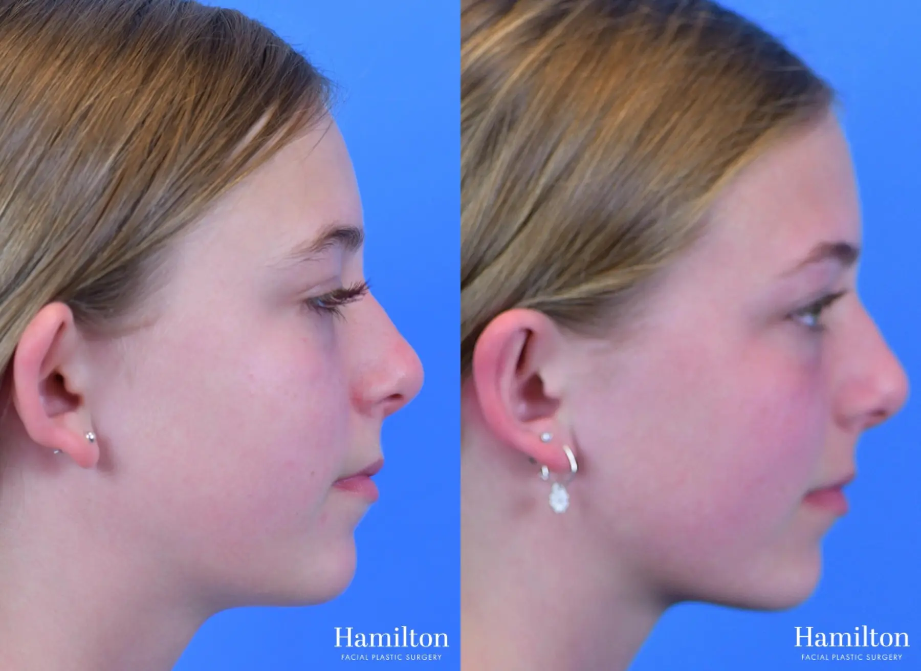 Otoplasty: Patient 2 - Before and After 4