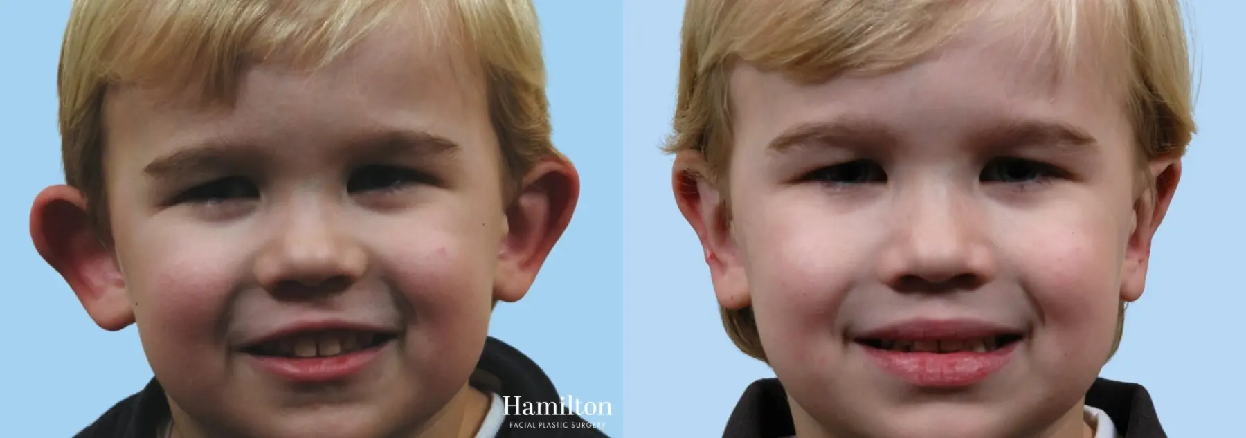 Otoplasty: Patient 3 - Before and After 1