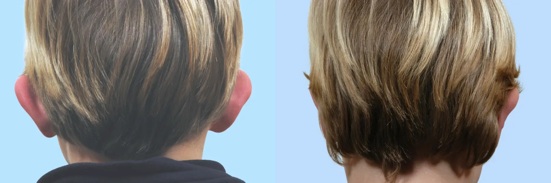 Otoplasty: Patient 3 - Before and After 2