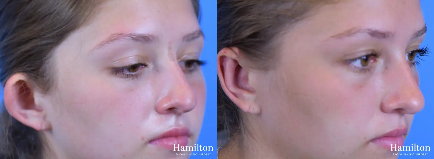 Otoplasty: Patient 1 - Before and After 3