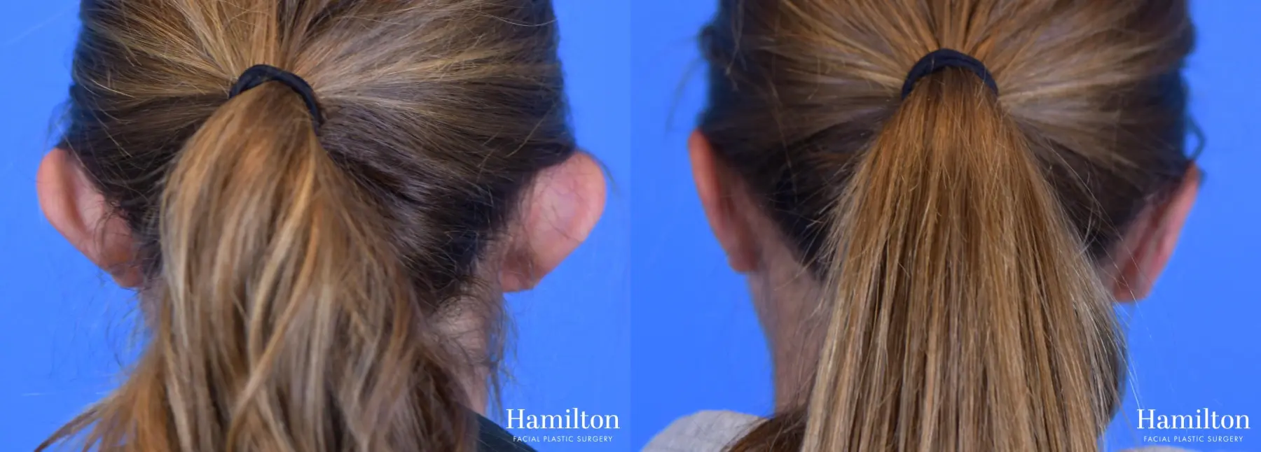 Otoplasty: Patient 1 - Before and After 2
