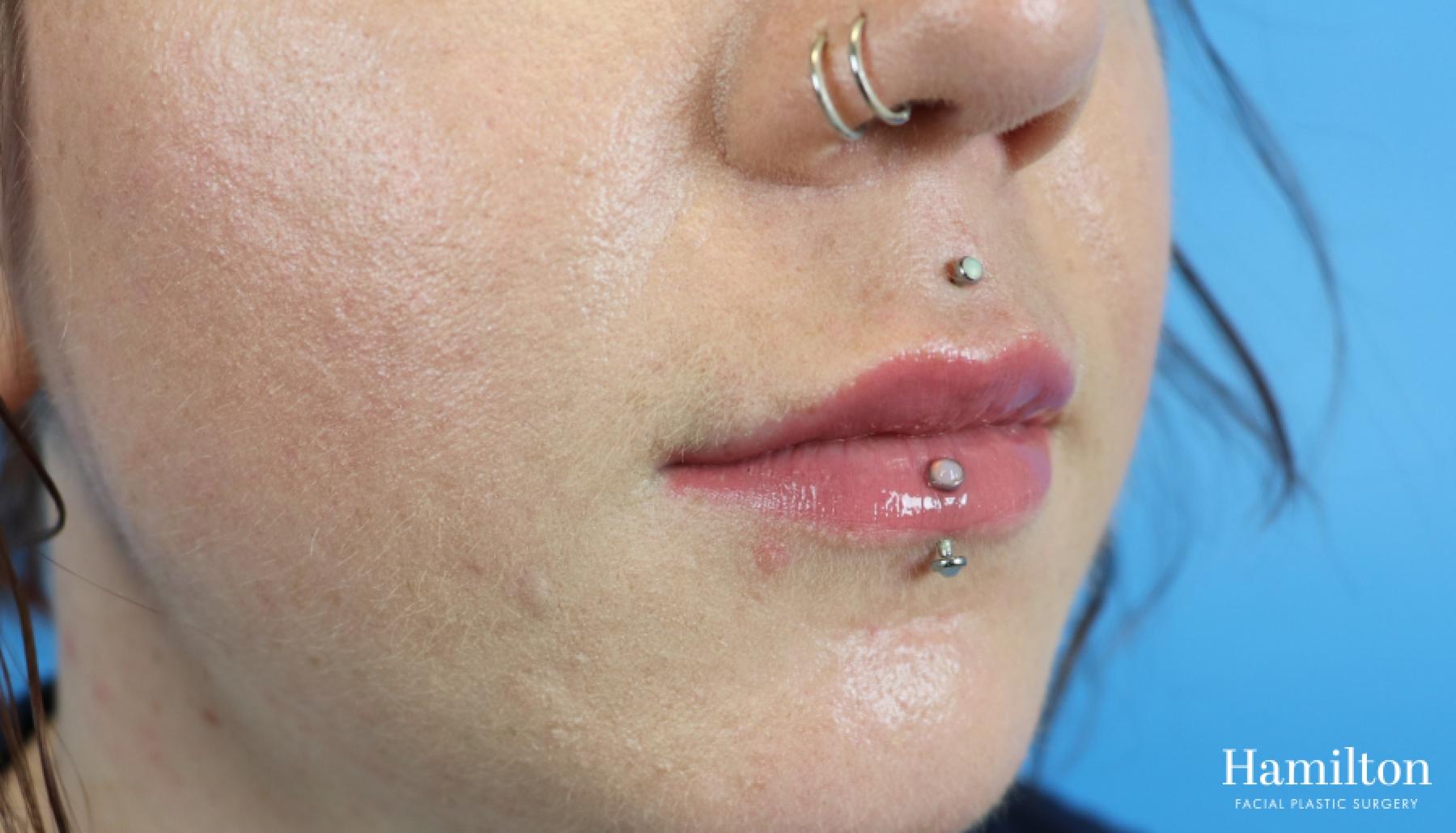 Fillers: Patient 7 - After 2