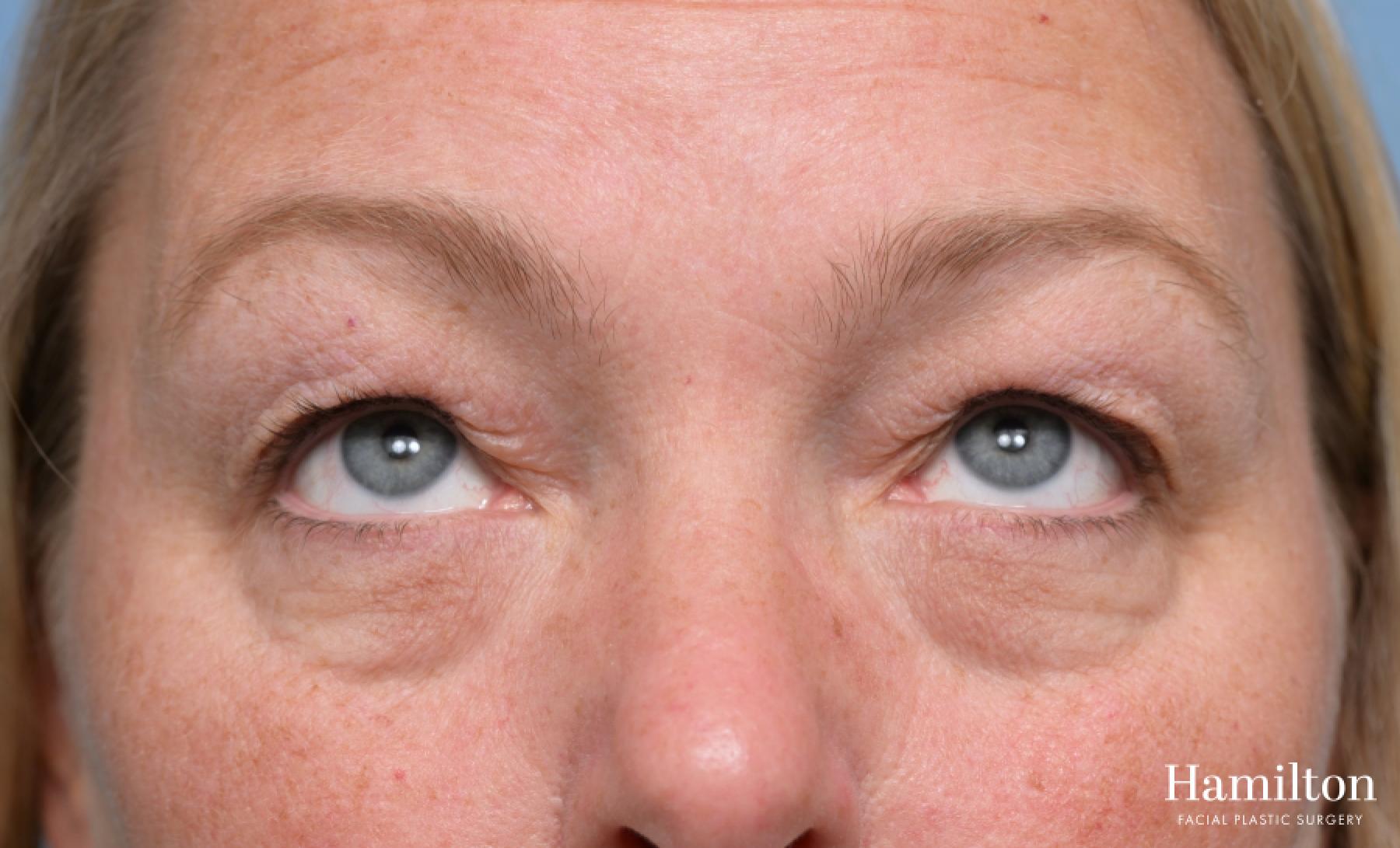 Blepharoplasty: Patient 2 - Before 2
