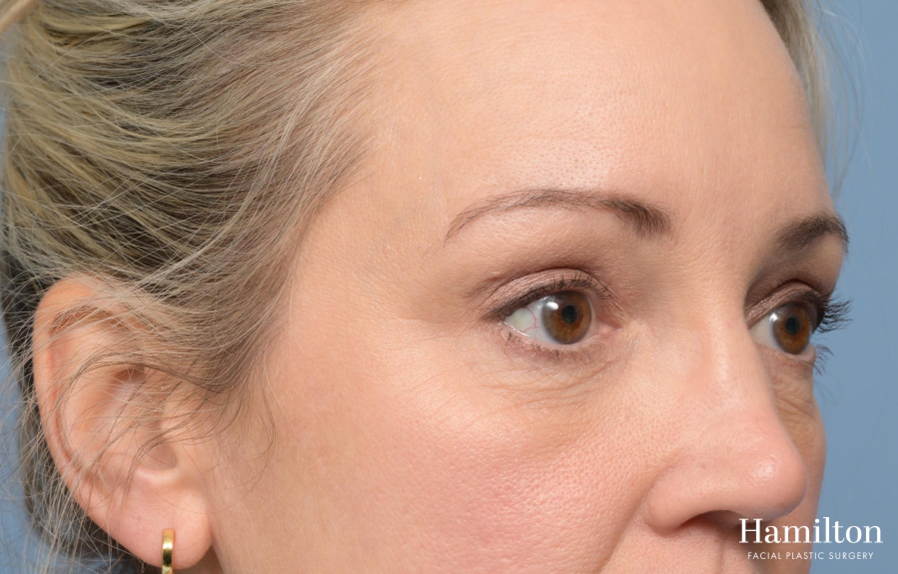Blepharoplasty: Patient 5 - After 5