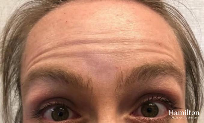Neurotoxins/Botox: Patient 7 - Before 1