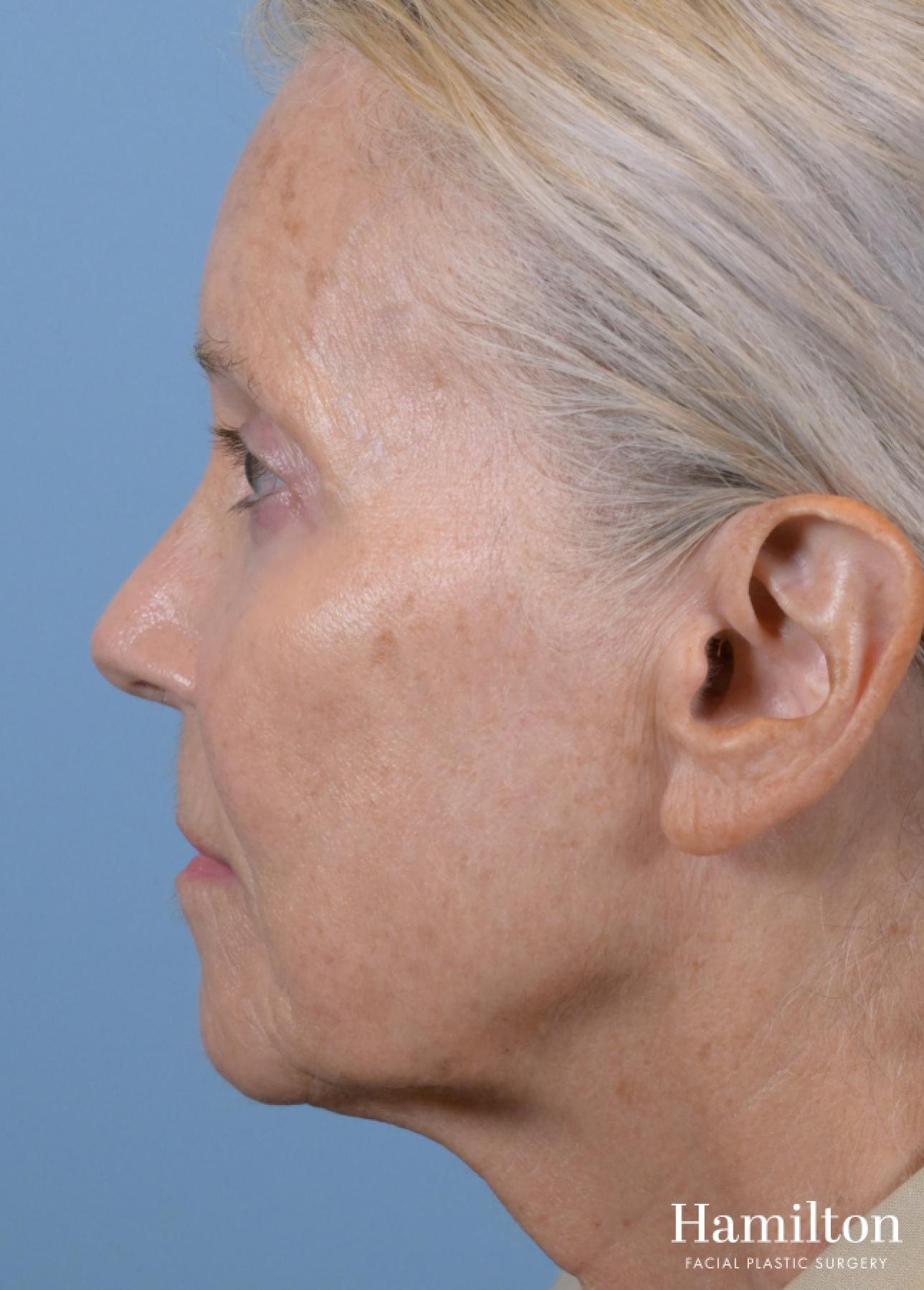 Facelift: Patient 3 - Before 3