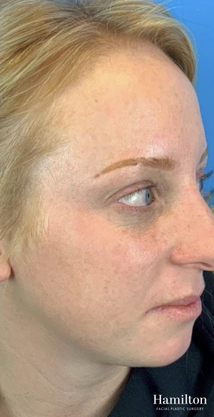 MOXI Laser: Patient 2 - After 2