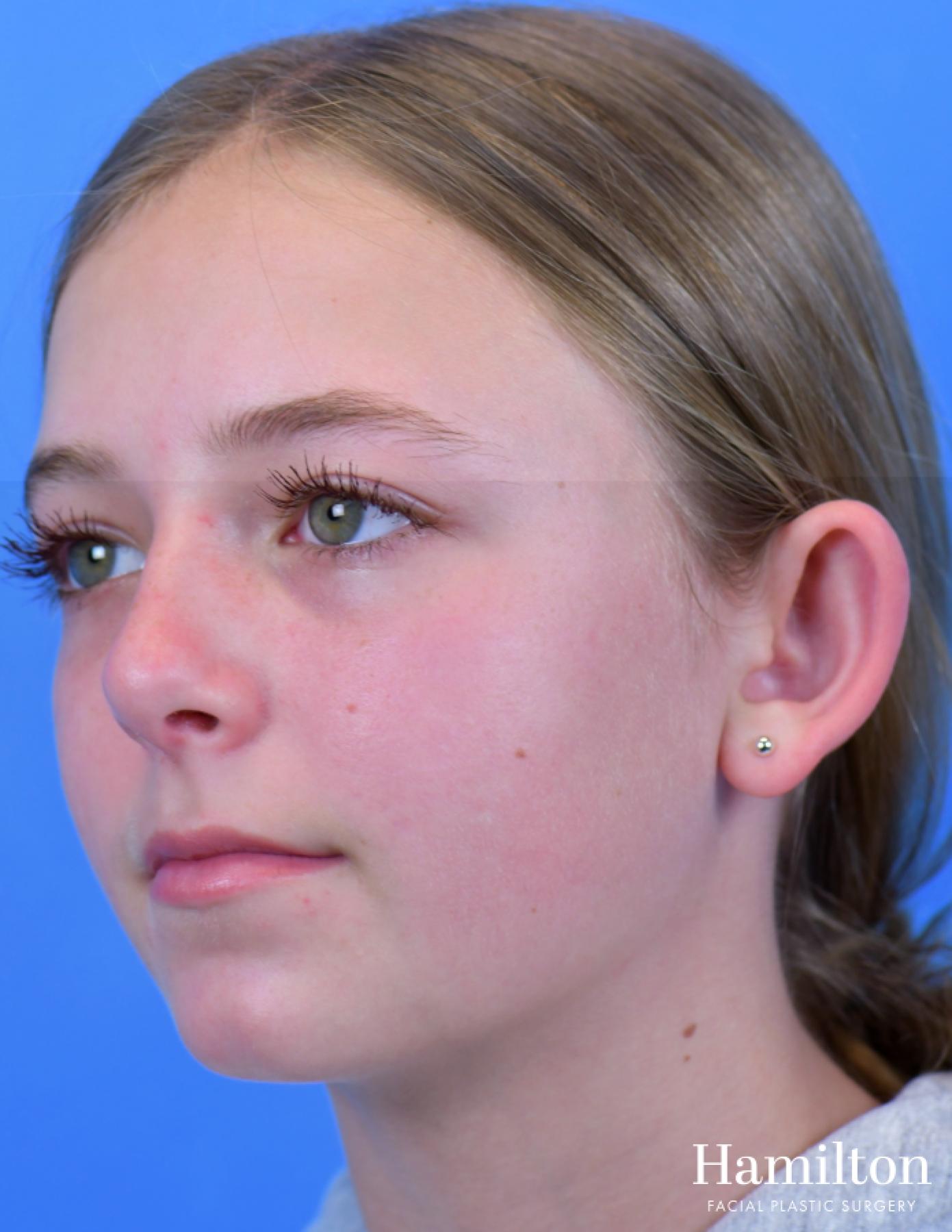 Otoplasty: Patient 2 - Before 2