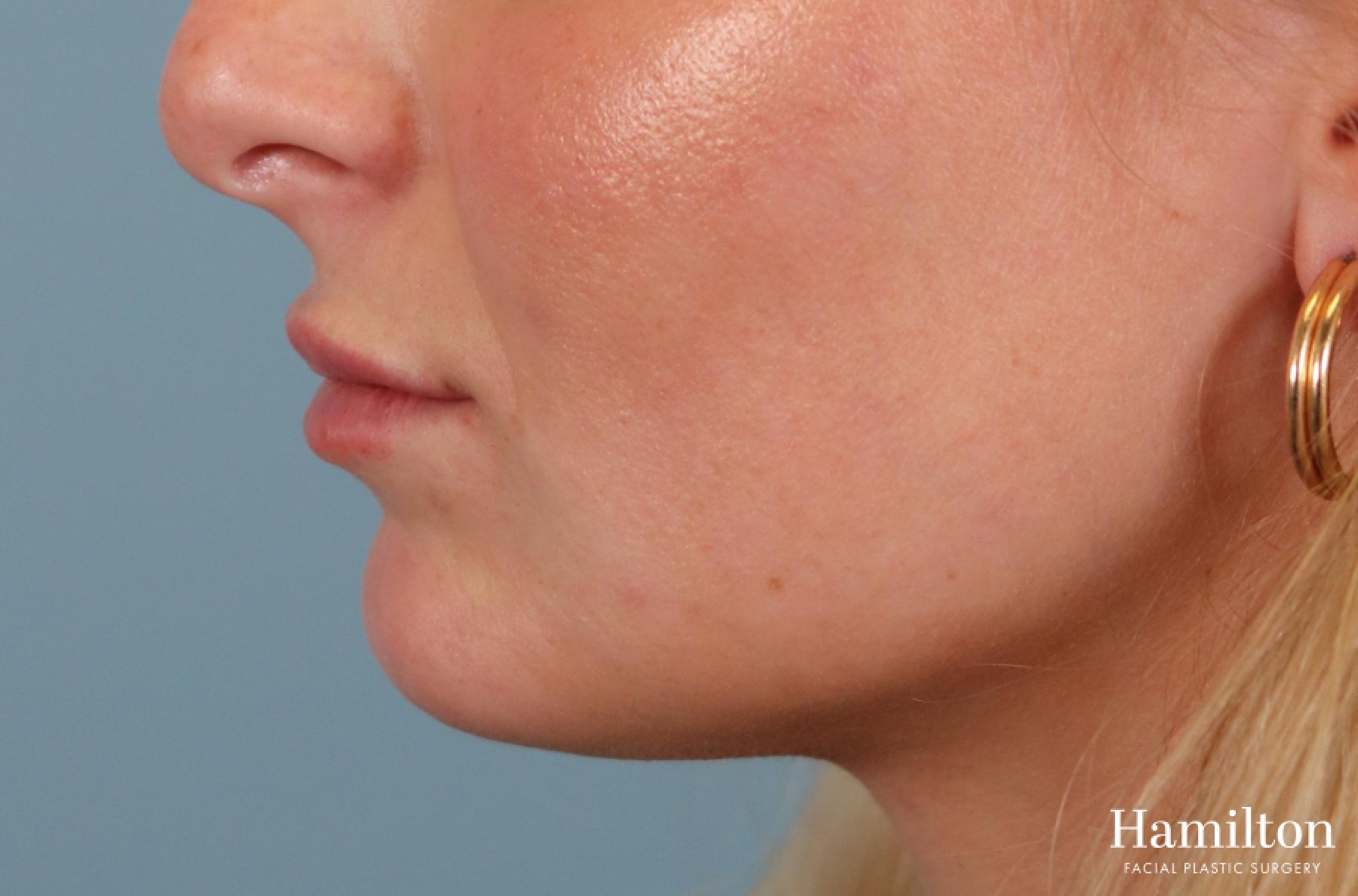 Fillers: Patient 9 - After 4