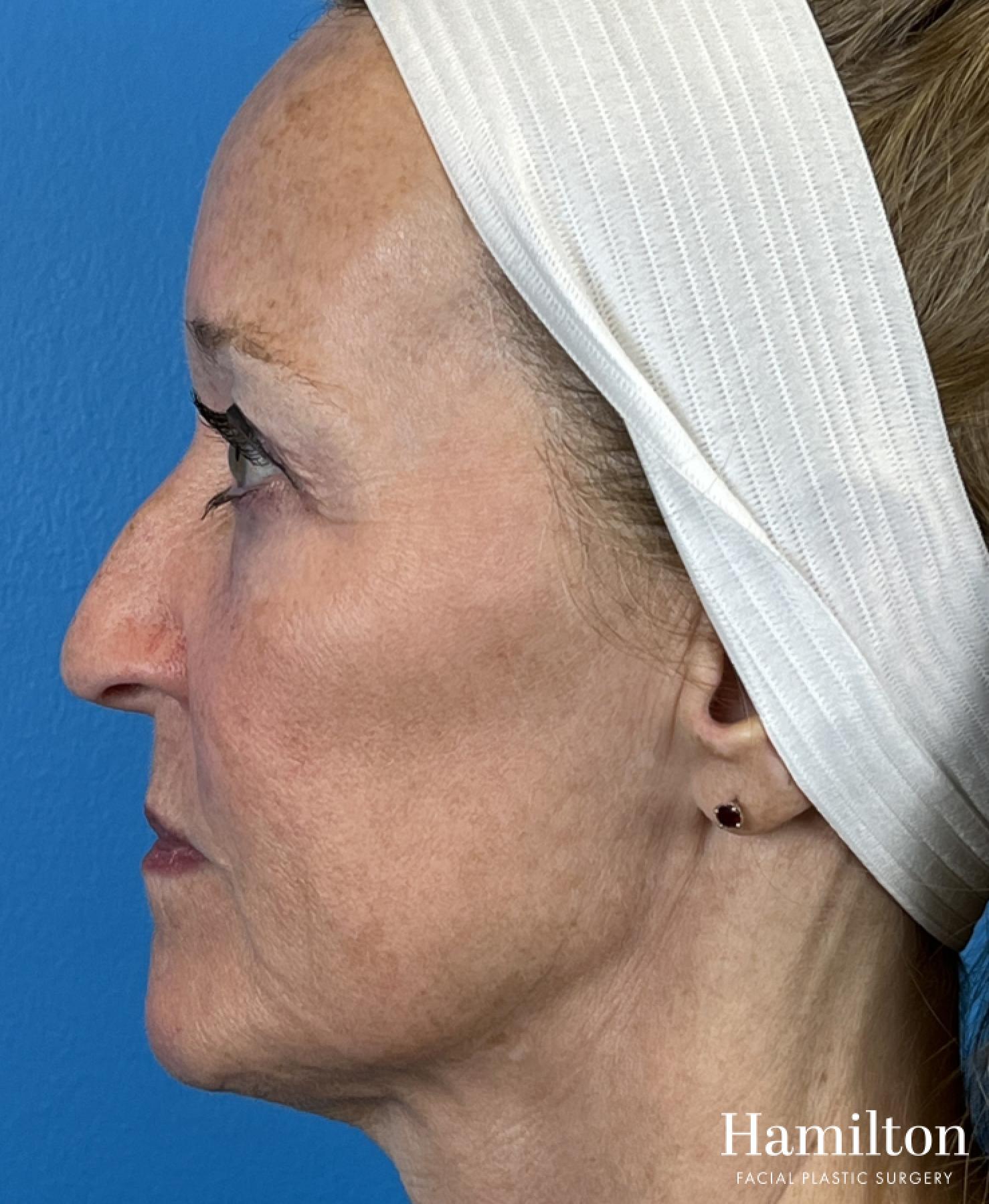 Broad Band Light (BBL): Patient 1 - After  