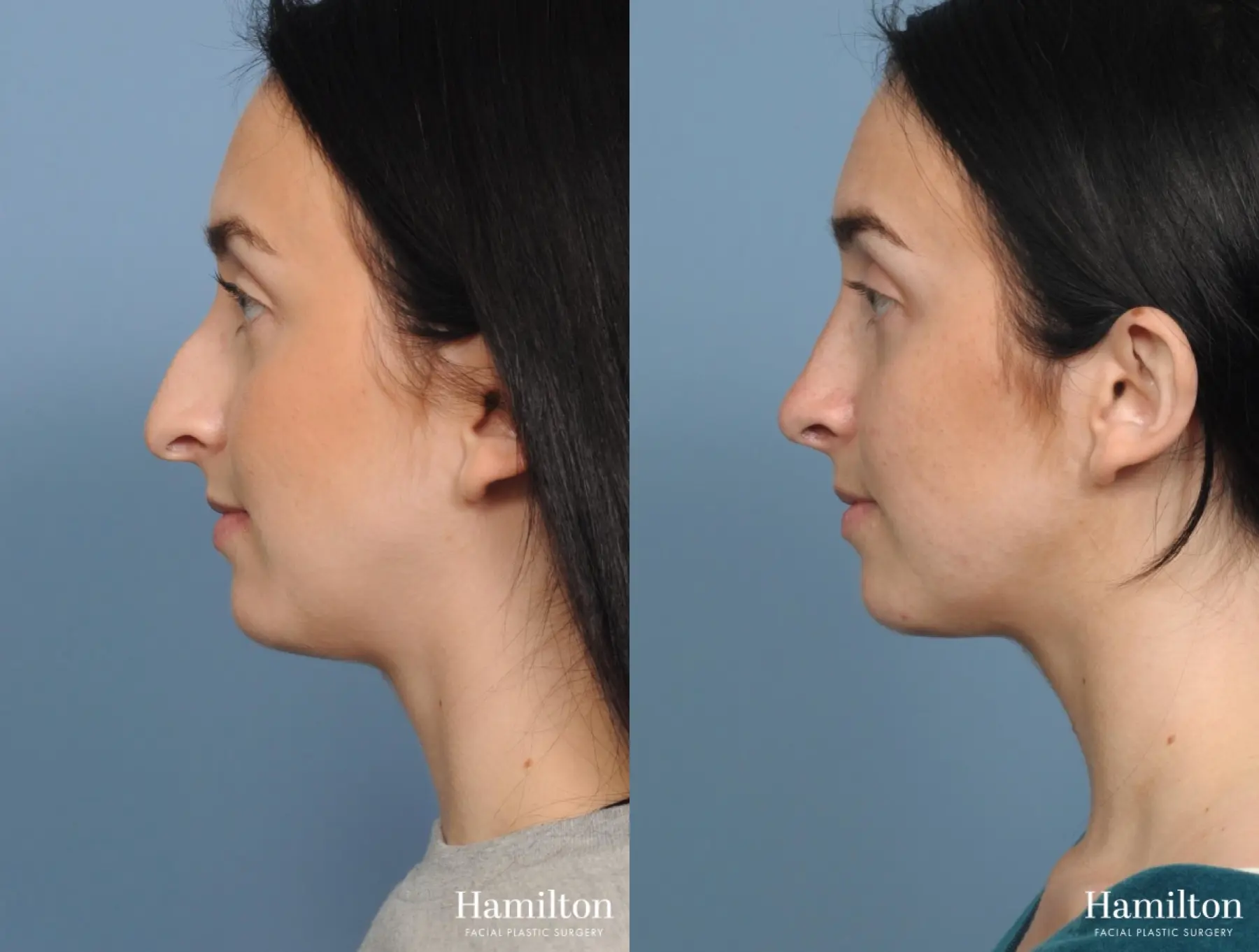 Rhinoplasty: Patient 4 - Before and After  