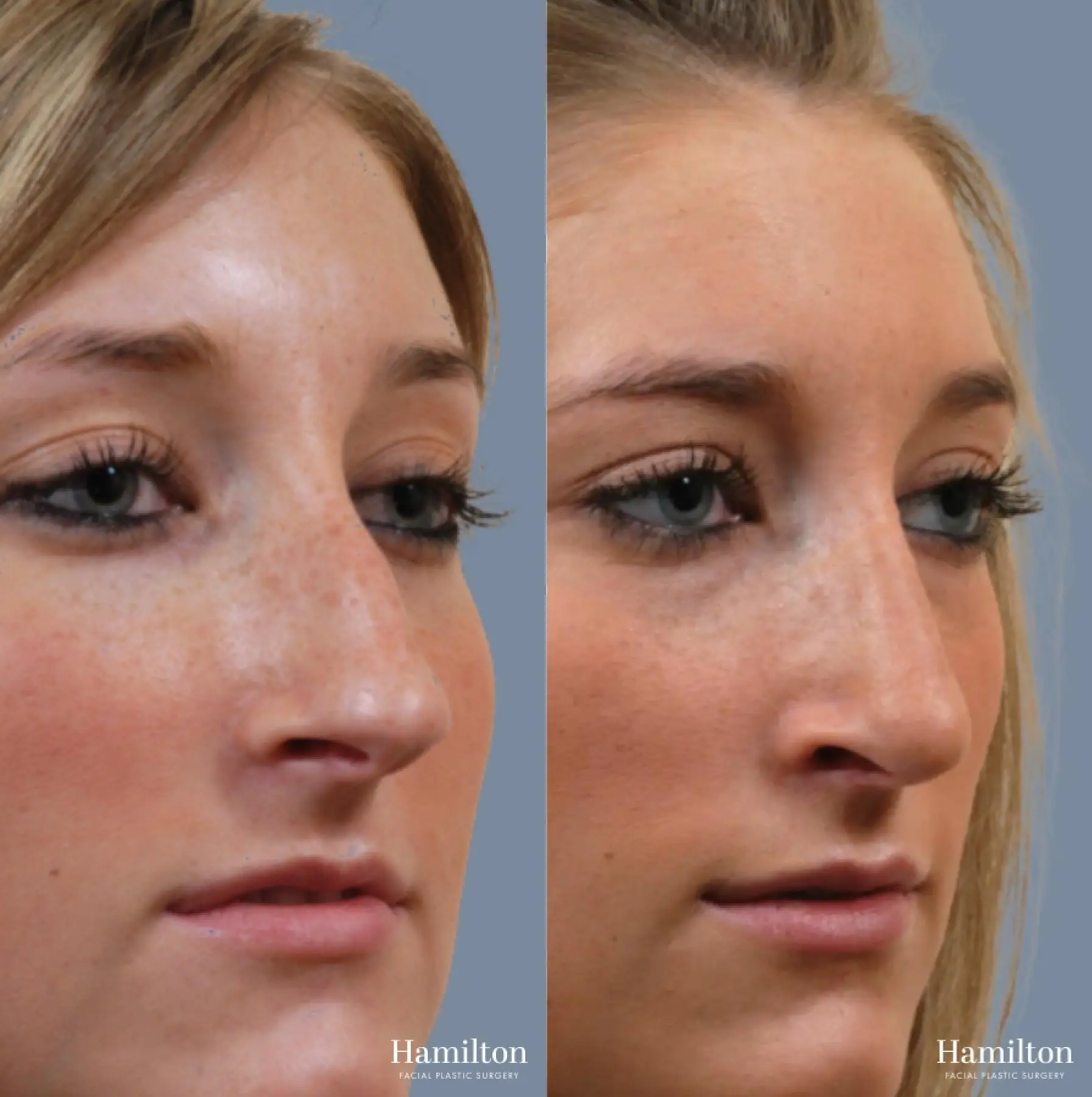 Rhinoplasty: Patient 9 - Before and After 3