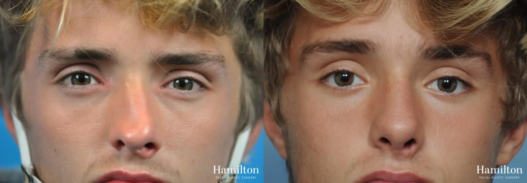 Rhinoplasty: Patient 14 - Before and After 1