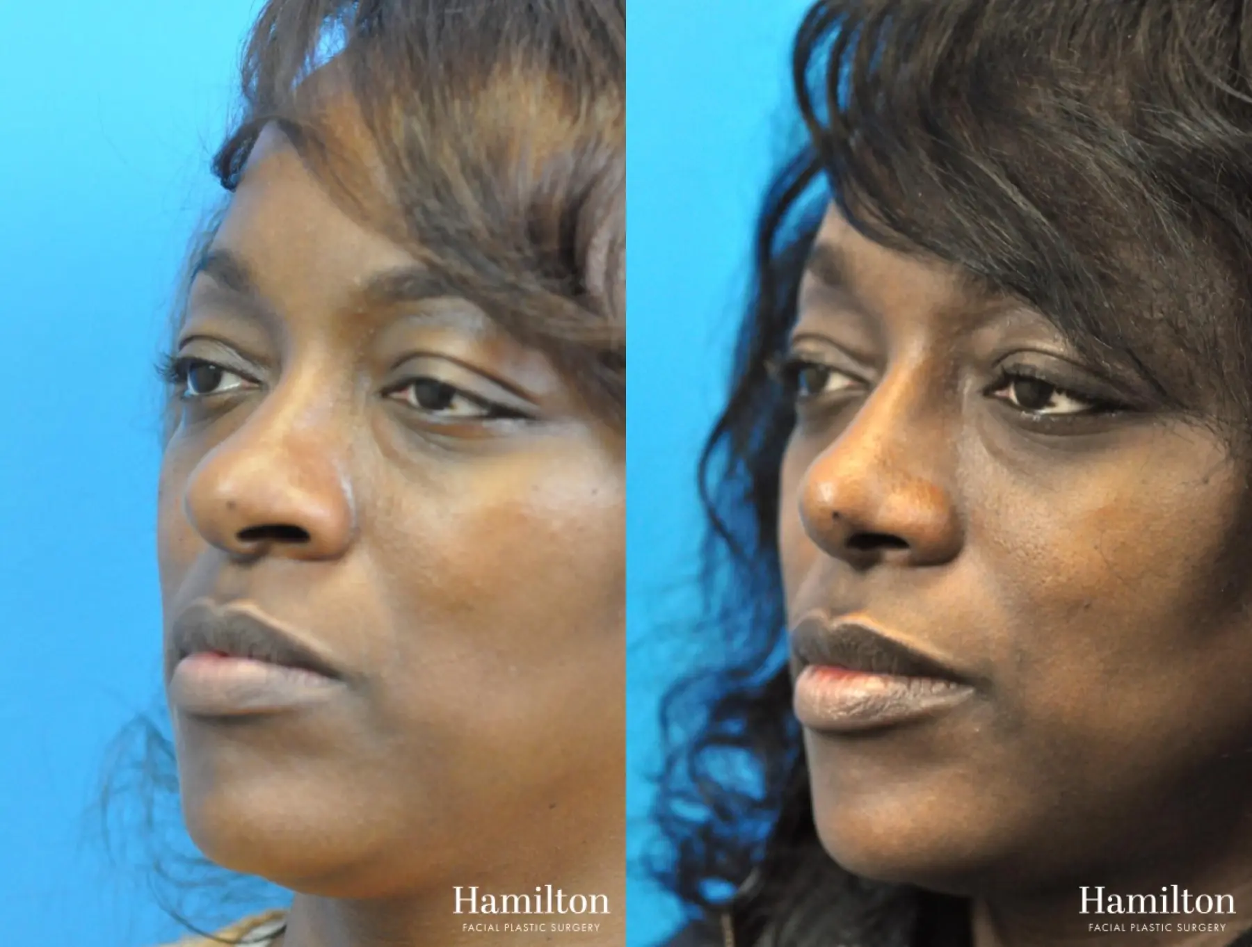 Rhinoplasty: Patient 28 - Before and After 5