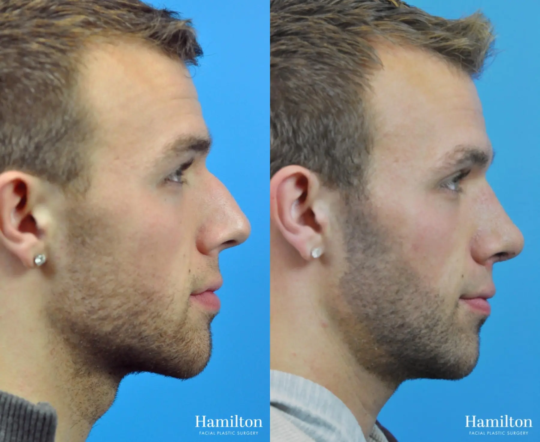 Rhinoplasty: Patient 7 - Before and After 2