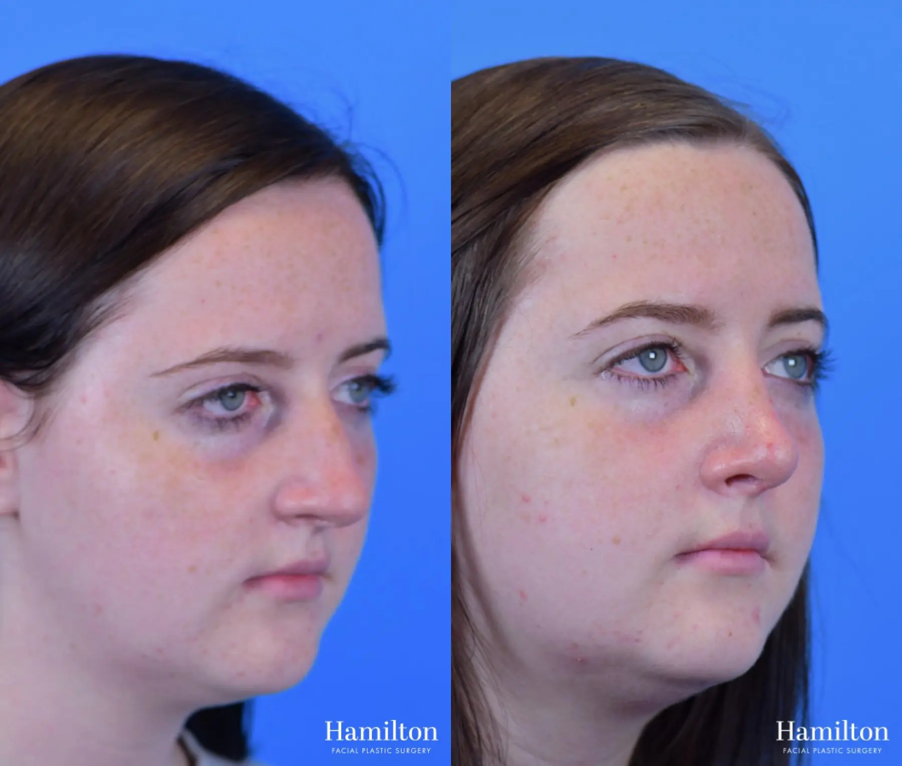 Rhinoplasty: Patient 44 - Before and After 3