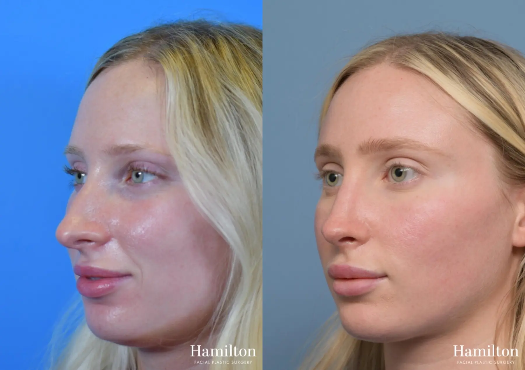 Rhinoplasty: Patient 4 - Before and After 4