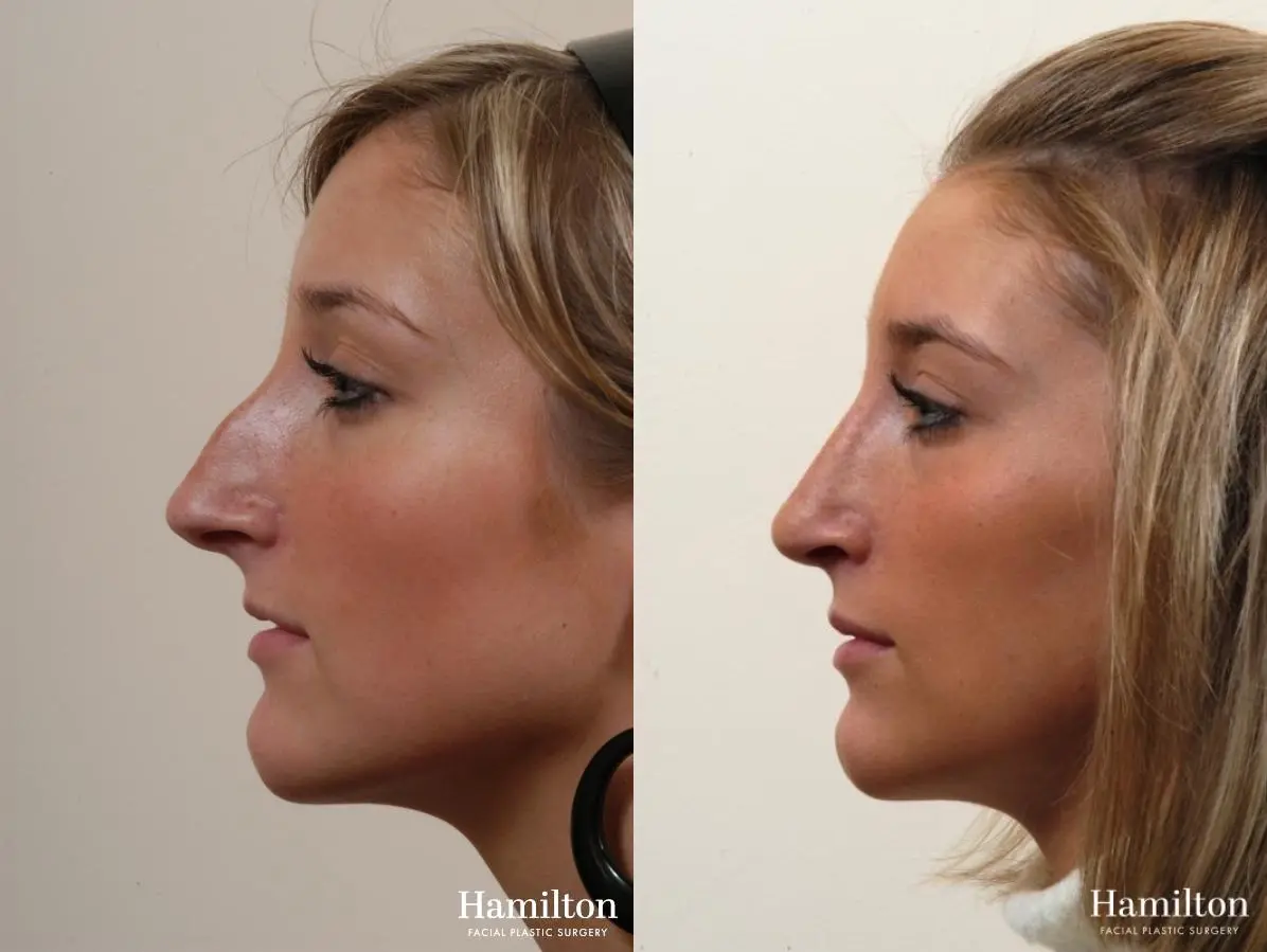 Rhinoplasty: Patient 5 - Before and After  