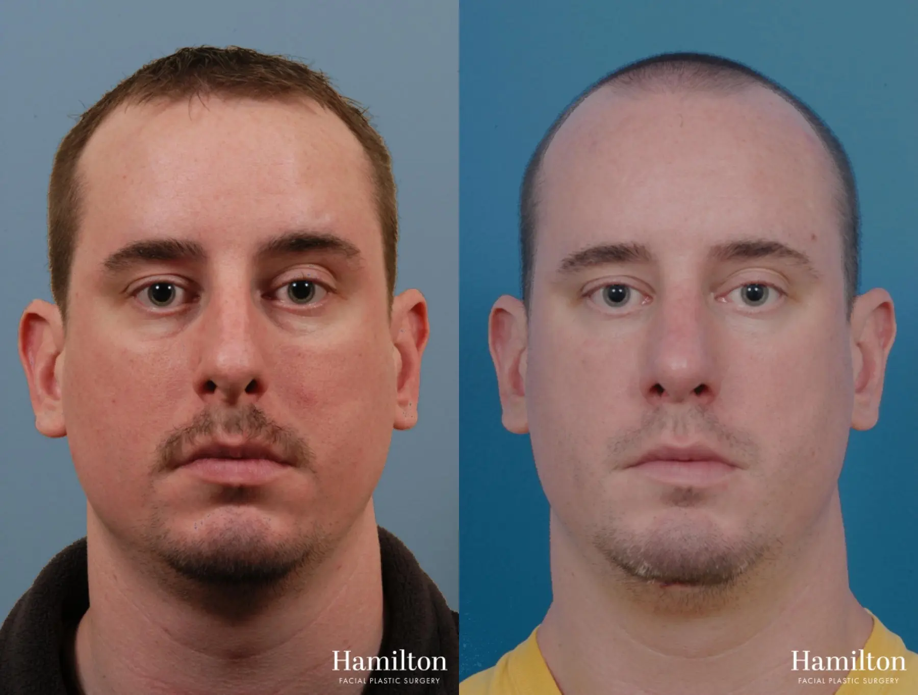 Rhinoplasty: Patient 45 - Before and After 3