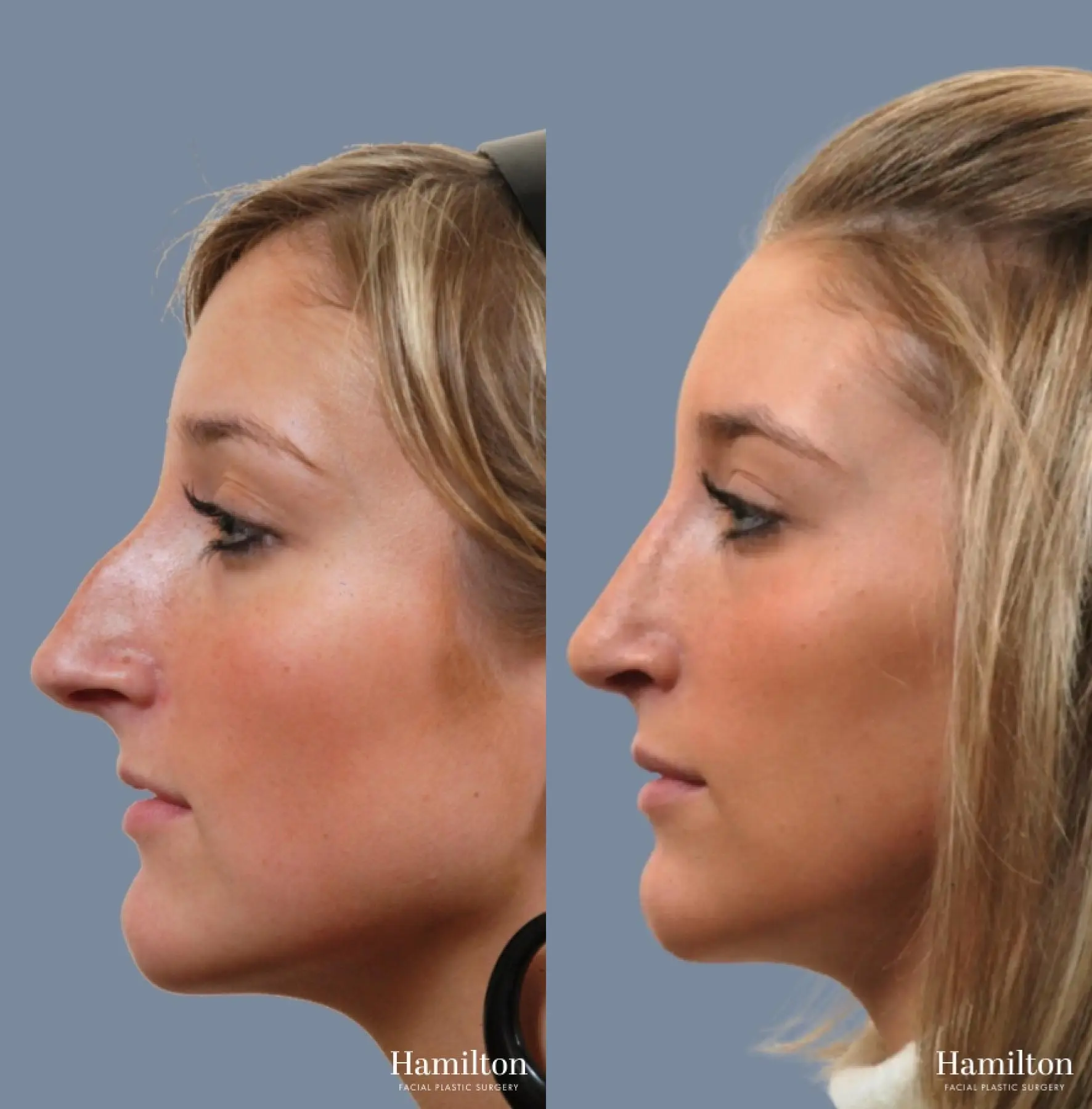 Rhinoplasty: Patient 9 - Before and After  